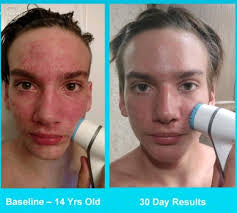 ageLOC Rose Gold LumiSpa® iO